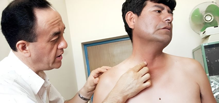 el 2013 registro 320 casos de cancer a la piel en los hospitales de lambayeque